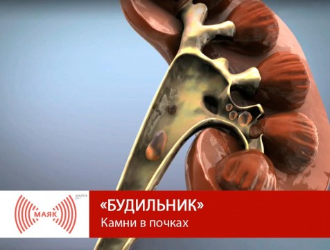 Будильник. Камни в почках