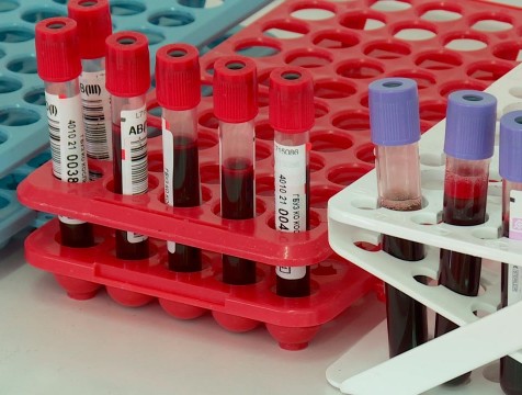 В Калужской области уменьшилось количество обследований на ВИЧ-инфекцию